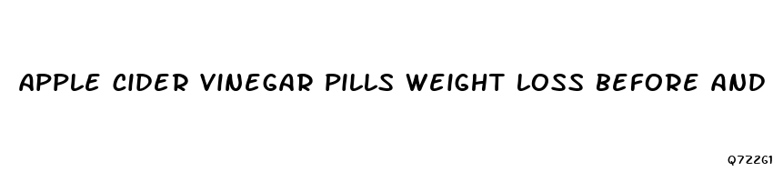 apple cider vinegar pills weight loss before and after